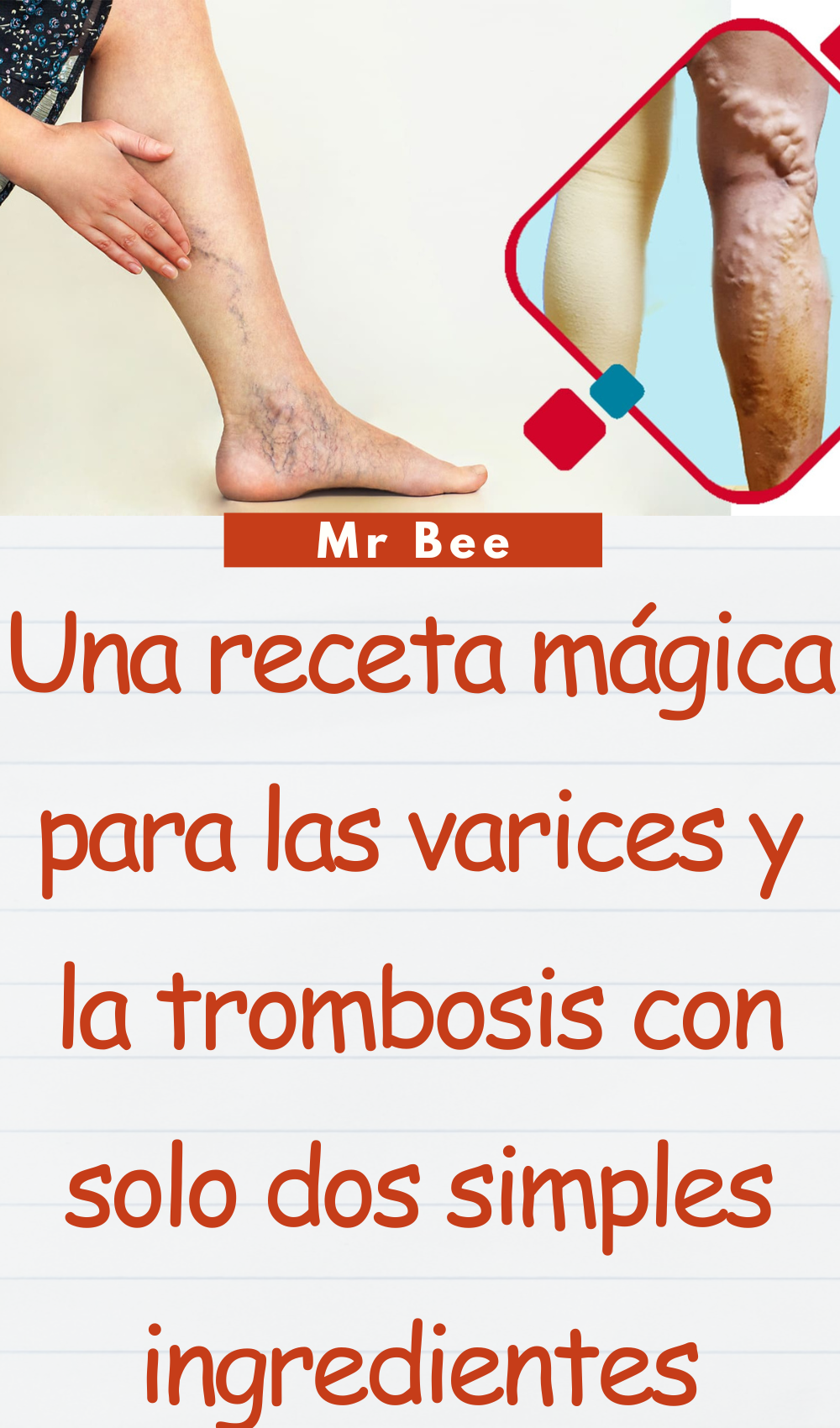 Una receta mágica para las varices y la trombosis con solo dos simples ingredientes Yo misma sane mis venas varicosas mi vecina y mi doctor me están pidiendo la receta dia y noche (1000 x 1700 px) (1000 x 1700 px) (17)